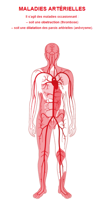 Maladies arterielle